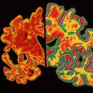 Alzheimer's affected brain (l) compared to healthy brain