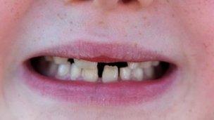 Child's teeth