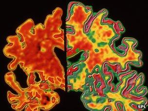 Alzheimer's brain scans