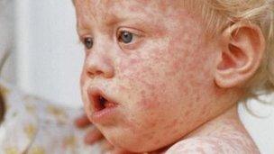 Boy with measles