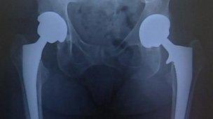 Hip replacement X-ray