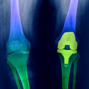 X-ray showing a knee replacement