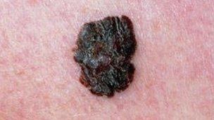 Melanoma