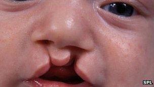 Baby with cleft lip