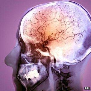 Angiogram of stroke patient