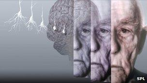 Computer artwork showing the brain of an elderly man affected by Alzheimer's disease