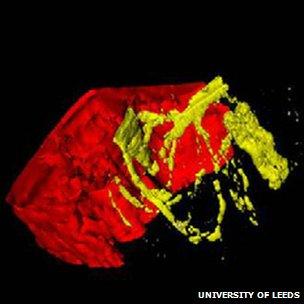 Metastatic colorectal carcinoma in human liver tissue