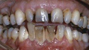 Reports last month suggested NI had the worst teeth in the UK