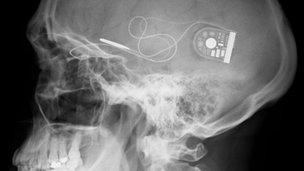 X-ray of skull showing position of chip with cable running to control unit