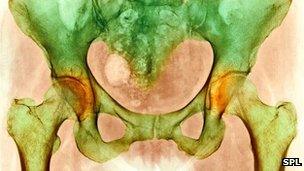 Osteoarthritis of the hip