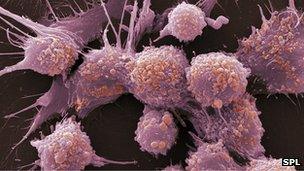 Prostate cancer cells