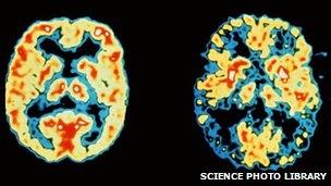 A PET scan of a regular brain (left) and one affected by Alzheimer's (right)