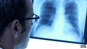 Doctor looking at lung x-ray