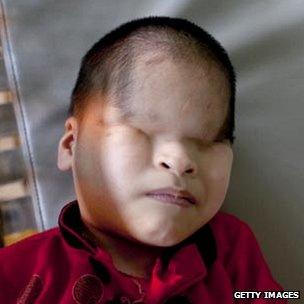 Child with Agent Orange-related deformity