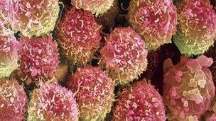 Lung cancer cells seen under a coloured scanning electron micrograph