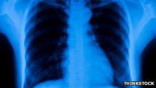 Chest x-ray