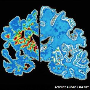 Computer graphic of a vertical (coronal) slice through the brain of an Alzheimer patient (at left) compared with a normal brain (at right).