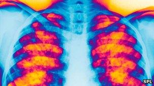 The lungs of someone with cystic fibrosis