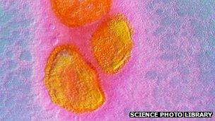 False-colour transmission electron micrograph (TEM) of 3 virus particles of the mumps virus