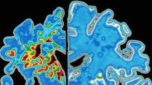 Computer graphic of a vertical (coronal) slice through the brain of an Alzheimer patient (at left) compared with a normal brain (at right).