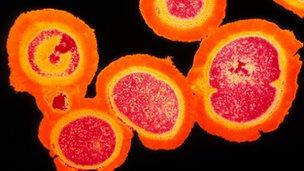 MRSA staphylococcus aureus bacteria