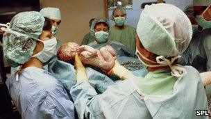 Baby born by Caesarean section