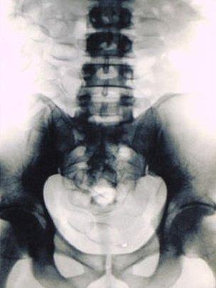 drugs x-ray