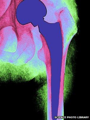 X-ray of an artificial hip