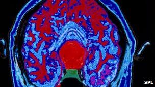 Coloured MRI scan of axial section through head