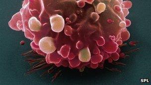 Bowel cancer cell