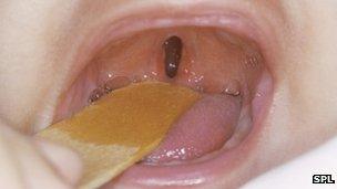 Cleft palate