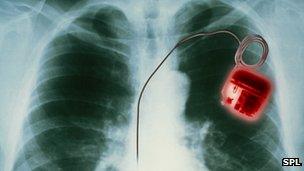 X-ray of pacemaker