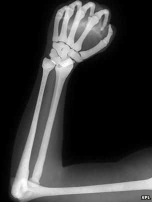 X-ray of clenched fist