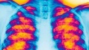 Cystic fibrosis x-ray