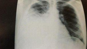 X-ray of John Amaechi's chest