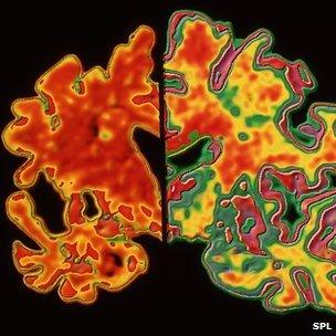 Alzheimer's affected brain (l) compared to healthy brain