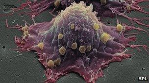 Bowel cancer cell