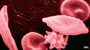 Red blood cell abnormalities caused by sickle cell disease