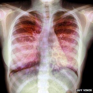 X-ray showing a build up of mucus in a patient's lungs