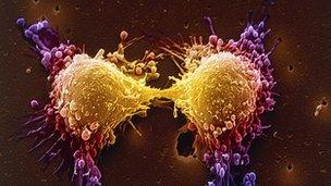 Coloured scanning electron micrograph of two prostate cancer cells in the final stage of cell division.