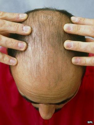 Man with thinning hair