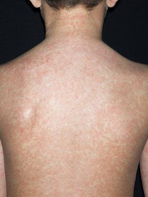 Boy with measles rash