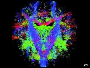 Nerve fibre bundles in the newborn brain, captured by MRI imaging