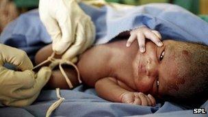 A baby having its cord tied before it is cut