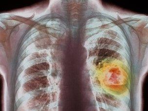 Coloured chest X-ray showing lung cancer in frontal view