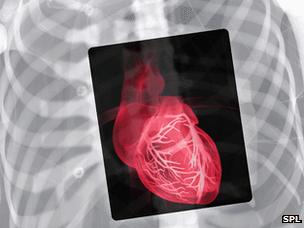 Heart X-ray