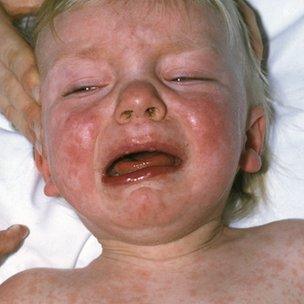 Child with measles