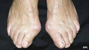 Bunions on a woman's feet