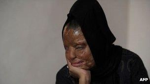 Indian acid attack survivor Sonali Mukherjee at home in Delhi on December 5, 2012