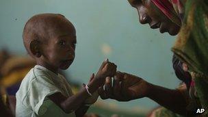 Child being treated for malnutrition at a clinic in Chad